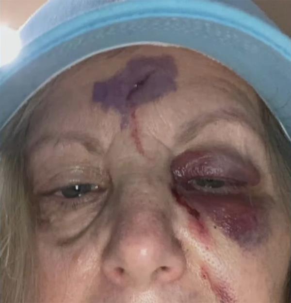 Howie Mandel's wifes face bruised' 