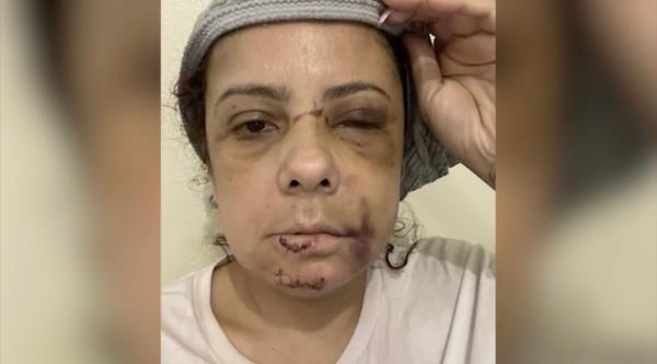 Woman with bruised and cut up face and swollen eye