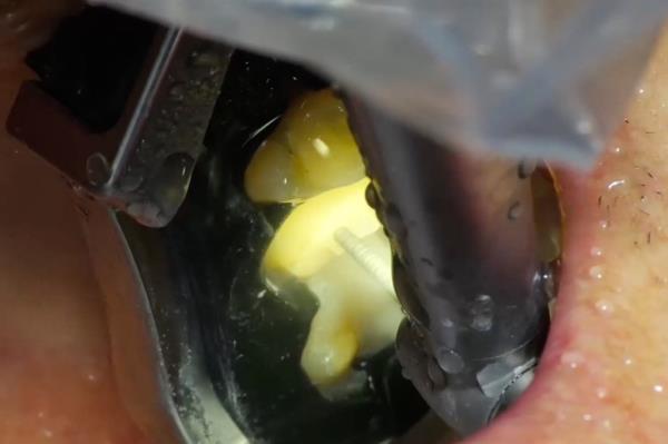 Perceptive's AI dentist performs the 