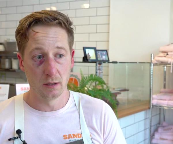 Harter with a bruised eye and forehead following the incident.