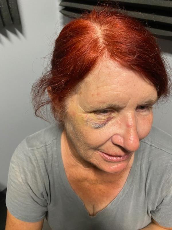 Do<em></em>nna Hansborough with black eye