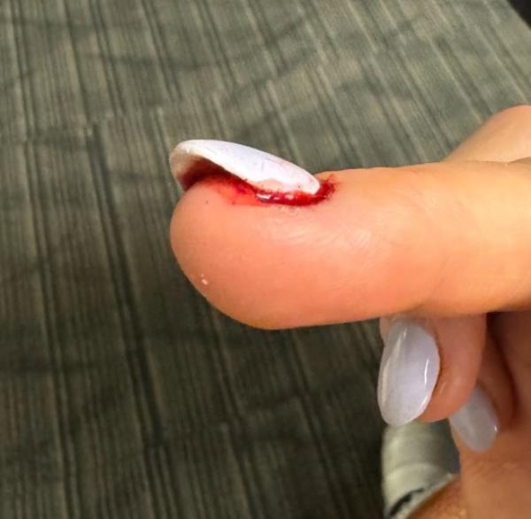 WWE superstar Natalya reveals gruesome injury